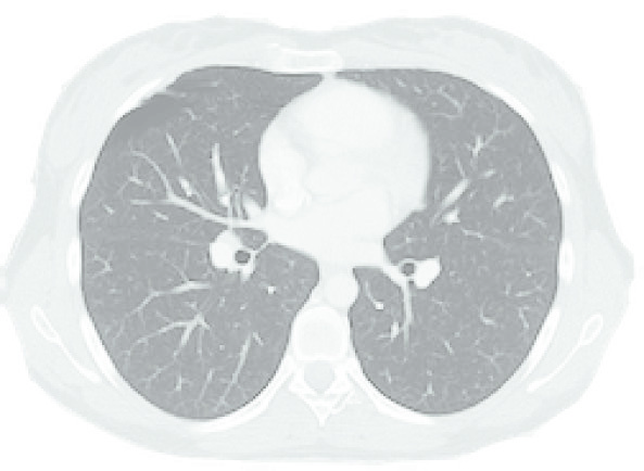 Corte axial de TC de tórax mostrando pulmões e mediastino usado para planejamento de radioterapia