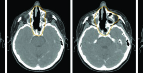 Tumores de Cavidade Nasal e Seios Paranasais