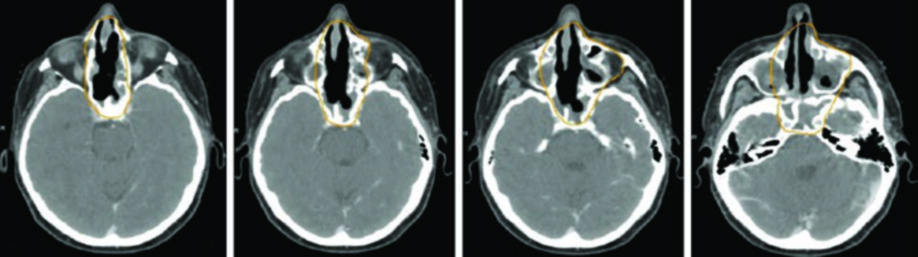 Cortes axiais de TC mostrando delineamento de CTV60 e CTV54 em caso de SNUC de cavidade nasal pós-operatório
