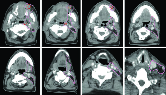 Cortes axiais de TC mostrando delineamento de GTV70 e CTV50 em carcinoma espinocelular avançado do seio maxilar com invasão da fossa craniana anterior