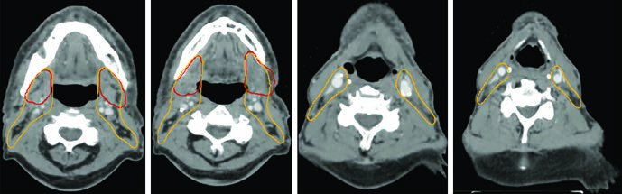 Cortes axiais de TC mostrando delineamento de volumes cervicais em caso de CEC da cavidade nasal com extensão extranodal