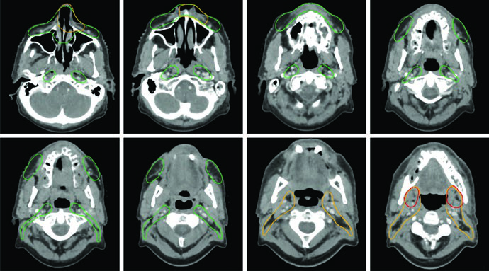 Cortes axiais de TC demonstrando delineamento de CTV54, CTV60 e CTV66 em caso de CEC da cavidade nasal anterior com extensão extranodal bilateral