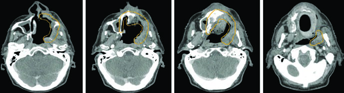 Cortes axiais de TC mostrando delineamento de GTV70 e CTV60 em carcinoma adenoide cístico do seio maxilar com cobertura de trajetos nervosos
