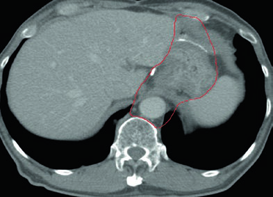 Cobertura do coto duodenal e cobertura opcional do hilo esplênico no CTV de câncer de antro gástrico