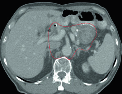 Detalhes de cobertura do CTV para tumor de antro incluindo anastomose gastrojejunal, estômago remanescente e ligamento hepatogástrico