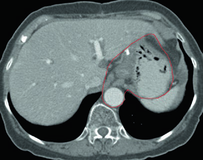 Cobertura da anastomose gastrojejunal e estômago remanescente no CTV de câncer gástrico do corpo