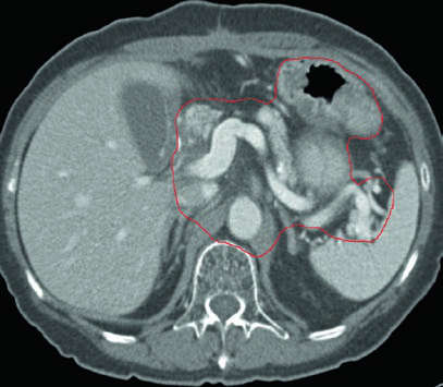 Detalhe da cobertura da artéria celíaca e hilo esplênico no planejamento de T3N3M0 gástrico do corpo