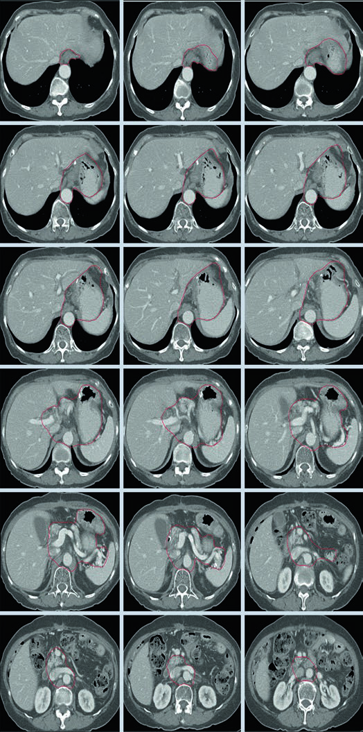 Cortes axiais de TC de planejamento mostrando CTV para adenocarcinoma T3N3M0 do corpo gástrico pós-gastrectomia distal