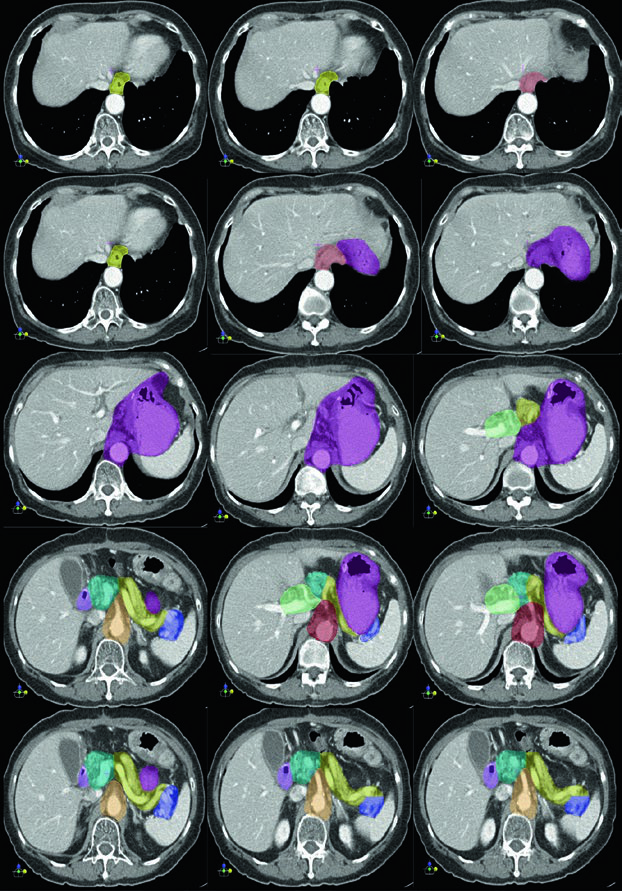 Distribuição dos grupos linfonodais e volumes clínicos alvo para radioterapia adjuvante do câncer gástrico incluindo cadeia celíaca, esplênica e porta hepática