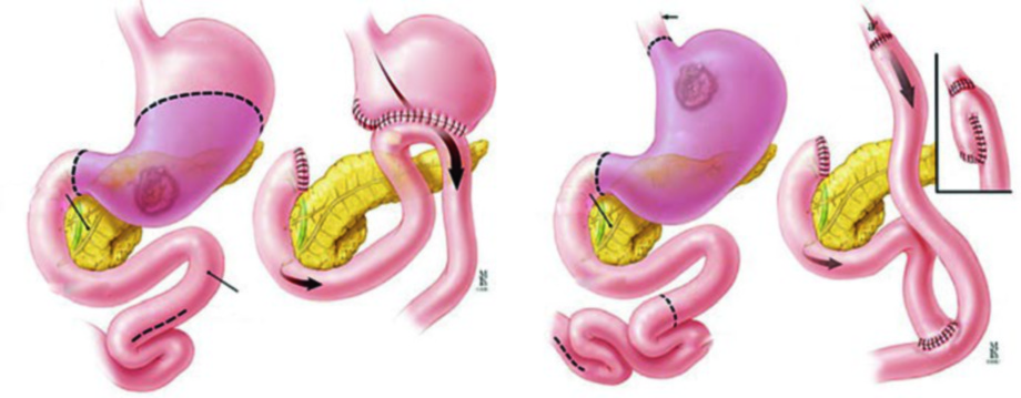 Tipos de cirurgia para câncer gástrico: gastrectomia total com reconstrução em Y de Roux e gastrectomia distal com alternativas de reconstrução