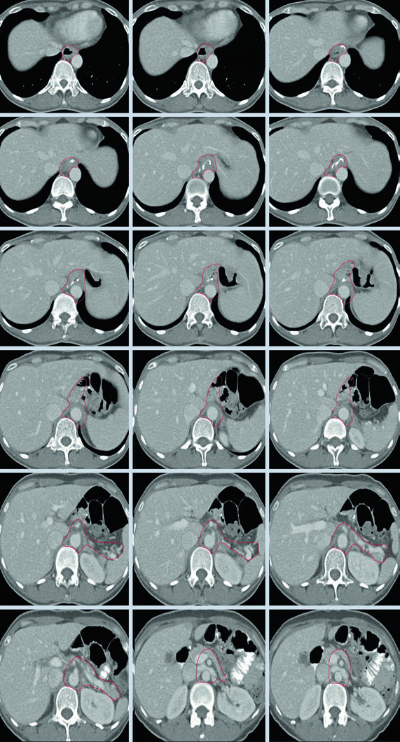 Cortes axiais de TC de planejamento mostrando delineamento do CTV para adenocarcinoma T1N1M0 da cárdia gástrica pós-gastrectomia total