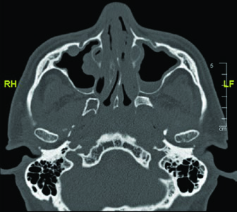 Axial CT at the jugular foramen level showing anatomical reference for the glossopharyngeal nerve exit from the skull base