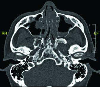 Axial CT showing the descending course of the glossopharyngeal nerve with oval marking at a lower cervical level