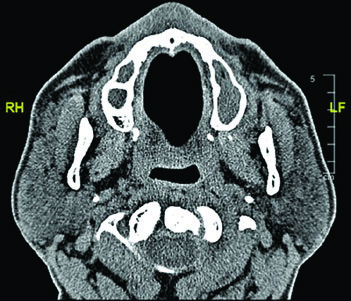 Axial CT at the mandibular level showing the expected course of the glossopharyngeal nerve anterolateral to the internal carotid artery, with red oval marking