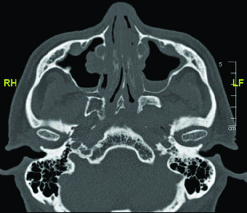 Axial CT at the skull base level showing the jugular foramen and styloid process, anatomical references for the glossopharyngeal nerve course