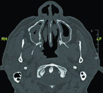 Axial CT bone window showing the upper course of the glossopharyngeal nerve near the styloid process