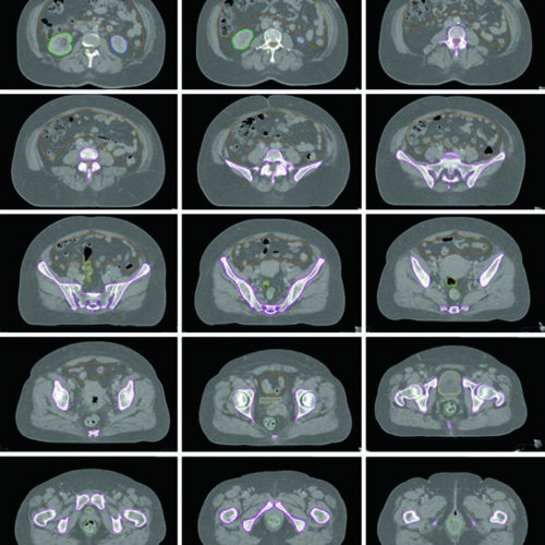Radioterapia Ginecológica Definitiva: Delineamento