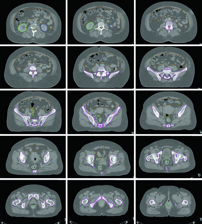 Definitive Gynecologic RT: Target Delineation