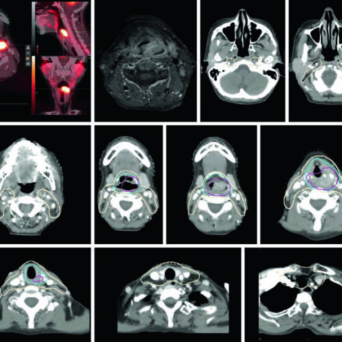 Carcinoma de Hipofaringe: Delineación y Campos