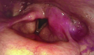 Imagen endoscópica de masa en seno piriforme con compromiso de pliegue ariepiglótico en carcinoma de hipofaringe