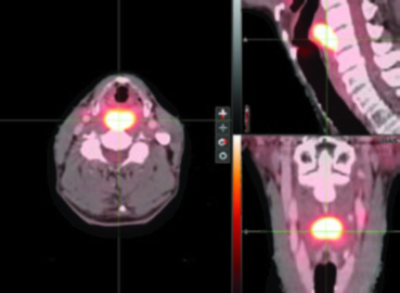PET/TC axial y coronal de carcinoma de pared faríngea posterior mostrando captación de FDG en hipofaringe