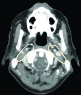 TC de planificación postoperatoria de carcinoma hipofaríngeo cT3N2c tras faringolaringectomía con cobertura bilateral retrofaríngea y niveles II-IV