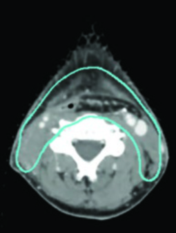 Corte axial de TC con delineación de CTV en carcinoma hipofaríngeo postoperatorio con contorno del lecho quirúrgico y cuello bilateral