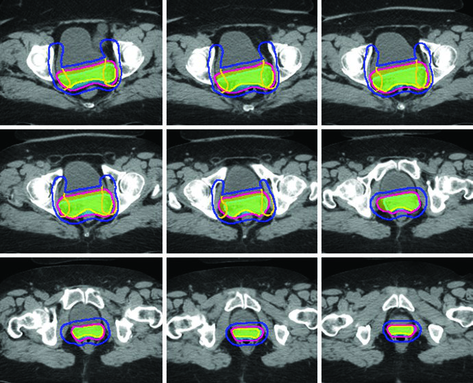 Example of internal target volume (ITV) to planning target volume (PTV) expansion with full and empty bladder scans fused for postoperative gynecologic IMRT planning