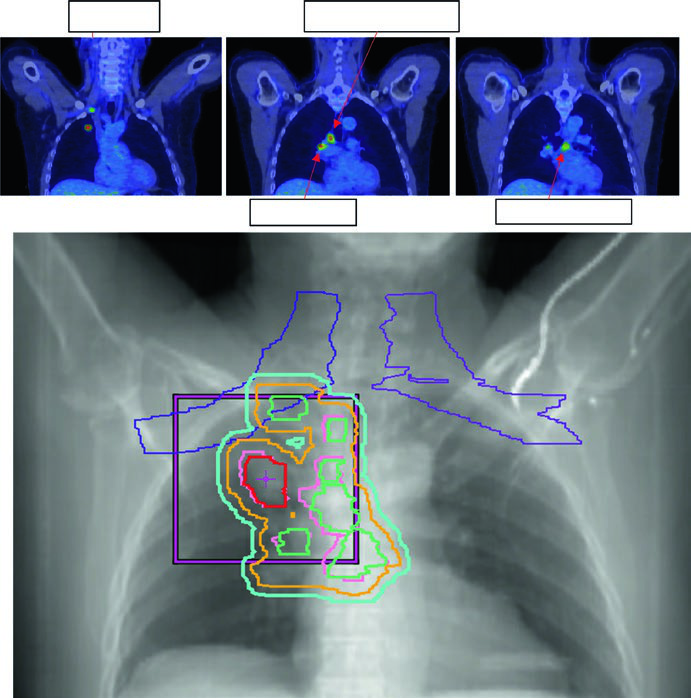 Planejamento de CPNPC localmente avançado estádio IIIB