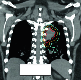 Replanejamento adaptativo por reaer ação pulmonar durante tratamento