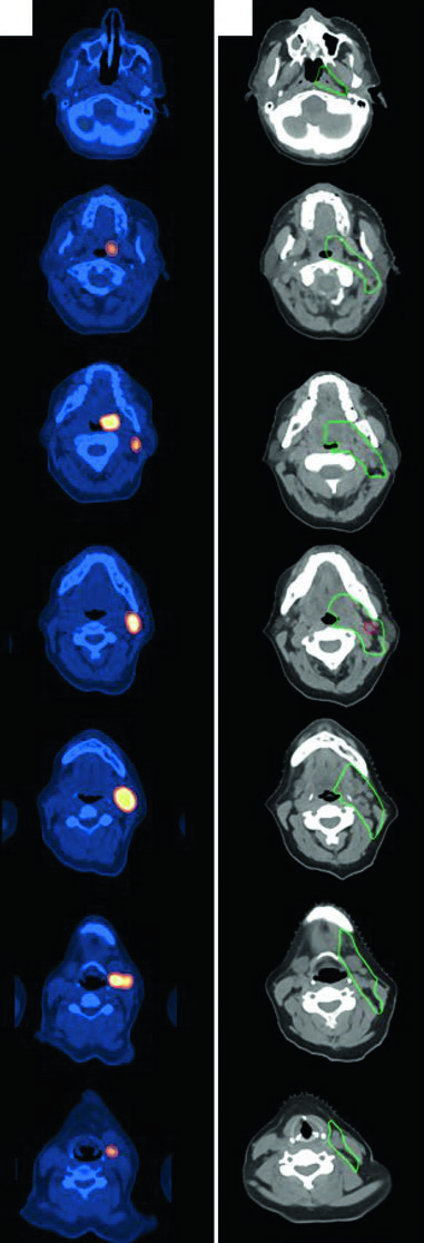 Cortes axiais de PET-CT e CT de simulação mostrando delineamento ISRT para linfoma difuso de grandes células B de tonsila esquerda e pescoço nível 2
