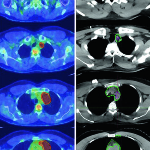 Linfoma de Hodgkin e Não Hodgkin: Delineamento RT