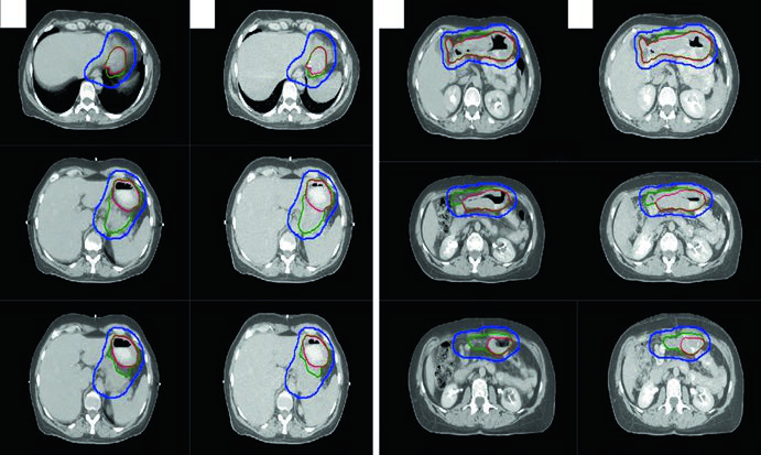 Cortes axiais de CT de simulação e 4D-CT MIP mostrando CTV e ITV para linfoma MALT gástrico difuso com envolvimento perigástrico
