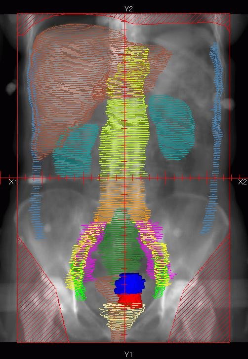 Equipamiento de dosimetría y planificación utilizado en braquiterapia y cálculo Monte Carlo de dosis