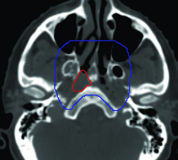 Ventana ósea mostrando base del cráneo con GTV y CTV
