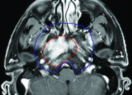 Fusión RM T1+GAD mostrando GTV y CTVs