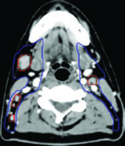 Cobertura del nivel V cervical con CTV56n