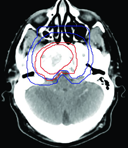 Contornos finales PTV70 y PTV56