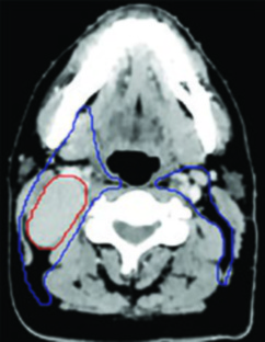 T1N1 NPC - nivel cervical con ganglios y CTV56n