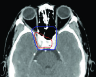 T4N2 NPC - corte axial TC con GTV70 y CTV56