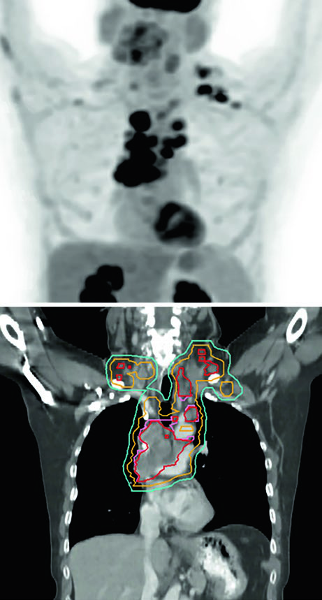 Planejamento CPNPC IIIC com SCV bilateral comprometida