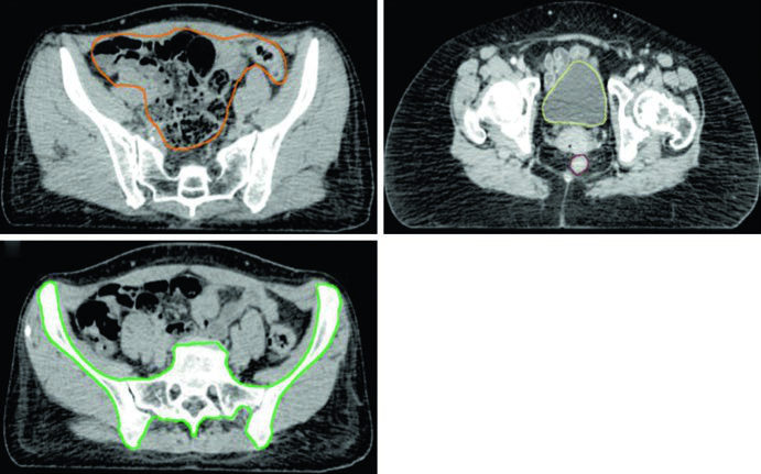 Organs at risk contours including bowel rectum bladder and bone marrow on representative CT slices for gynecologic pelvic IMRT planning