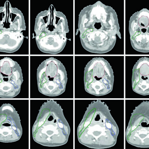 Cavidade Oral: Delineamento de Volumes-Alvo