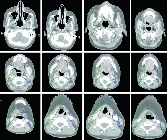 Cavidad Oral: Delineación de Volúmenes Blanco