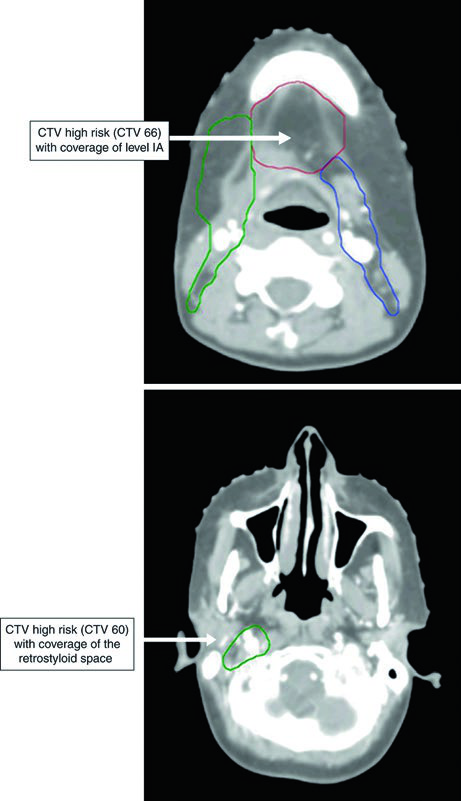 Cortes axiales mostrando cobertura del nivel IA y uso de bolus en carcinoma de lengua oral postoperatorio