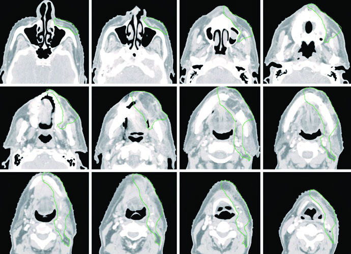 Delineación de CTV60 en verde para carcinoma de mucosa yugal T4aN0 post-resección con mandibulectomía marginal