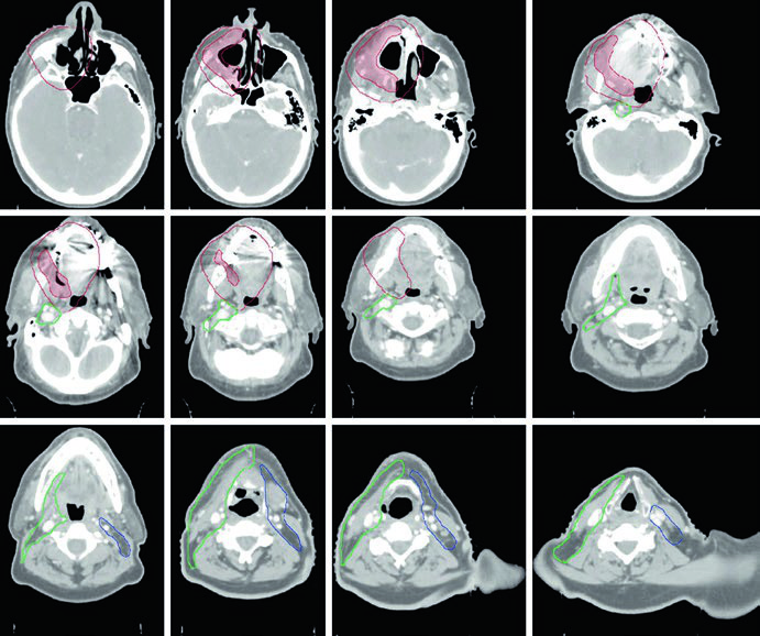Delineación de volúmenes blanco para carcinoma de trígono retromolar T4aN2b con compromiso del pterigoideo medial y enfermedad residual macroscópica
