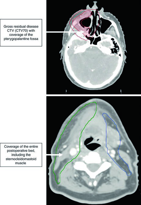 Cobertura de la fosa pterigopalatina y del lecho operatorio en carcinoma de trígono retromolar postoperatorio