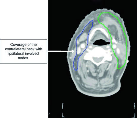 CTV54 en azul cubriendo niveles ganglionares contralaterales I a IV en carcinoma de encía T4aN1 con enfermedad nodal positiva