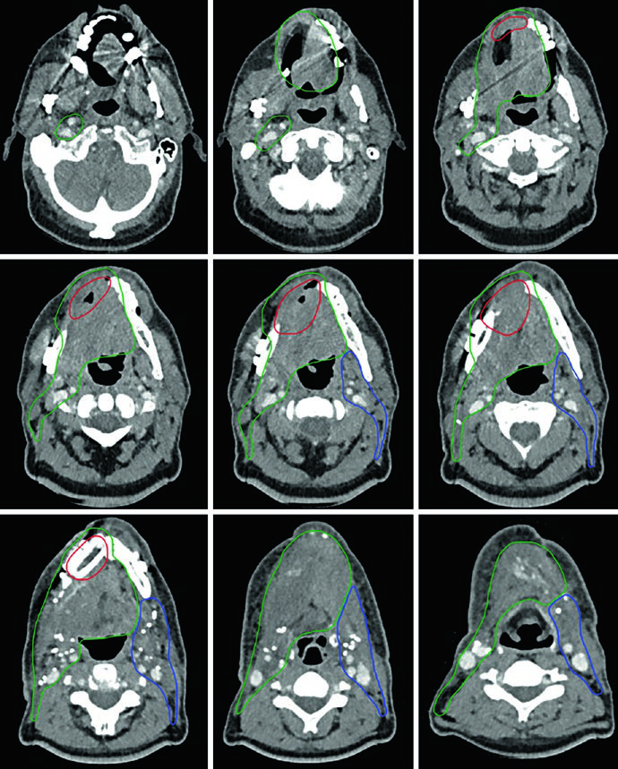Delineación de CTV66 en rojo, CTV60 en verde y CTV54 en azul para carcinoma de piso de boca T4aN2b post-hemimandibulectomía